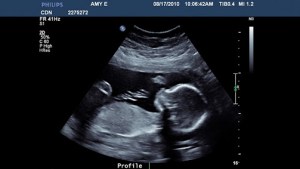 Mobile ultrasound aims to reach abortion-vulnerable women – ar