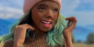 O inspirador exemplo de superação de uma mulher atacada com ácido quando era bebê